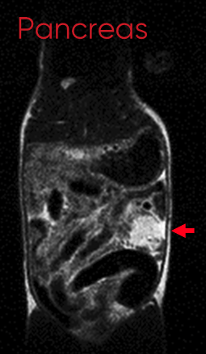 blog-image-pancreatic-MRI